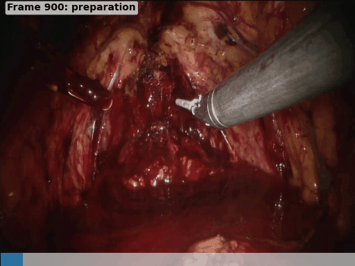 Animated visualization of surgical action segmentation showing real-time detection and classification of surgical instruments and procedures in laparoscopic surgery video